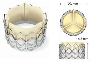 Transcatheter heart valve measurements: 23 mm top, 14.3 mm side view.