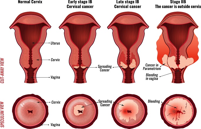 cervical cancer stages