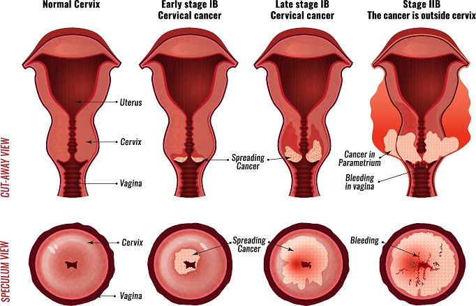 cervical cancer causes