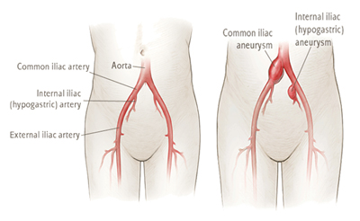 common iliac artery ectasia