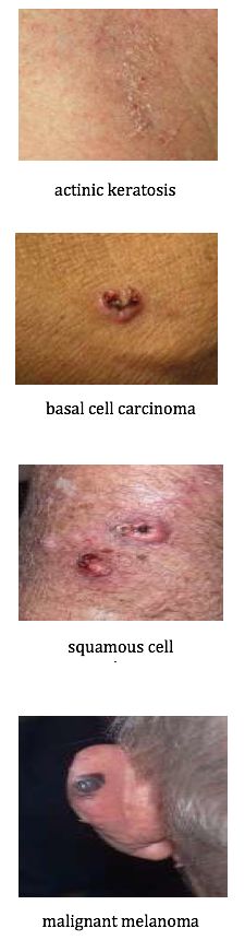 skin cancer types squamous cell carcinoma