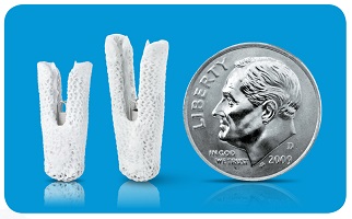 Bone graft material compared to a dime for size reference.